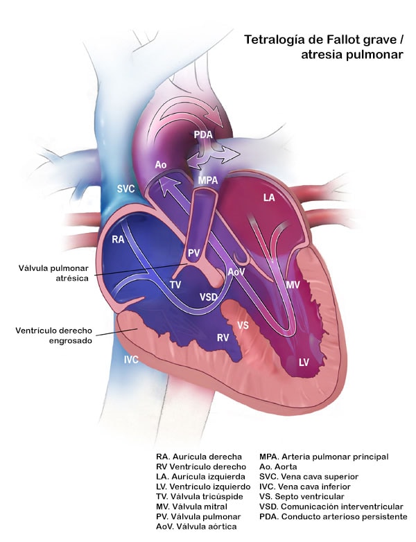 Tetralogía de Fallot grave atresia pulmonar