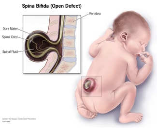 Spina Bifida (Open Defect) Diagram