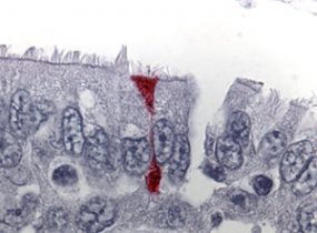 Photomicrograph of an immunohistochemical stain of respiratory tissue infected with SARS coronavirus.
