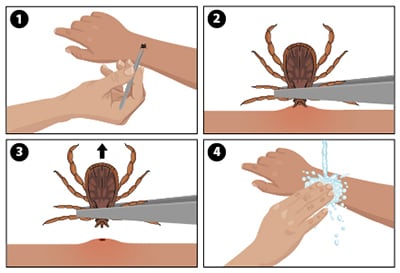 : Sequence of how to remove an attached tick.