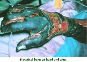 electrical burn on hand and arm