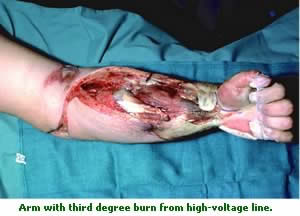 arm with third degree burn from high voltage line