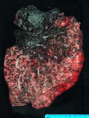 Lung of former coal miner with severe black lung.