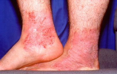 Skin Rashes On Lower Legs - Doctor answers on HealthTap
