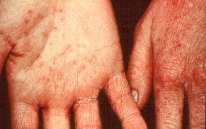 Irritant+contact+dermatitis+pictures