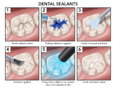 Dental Sealants example