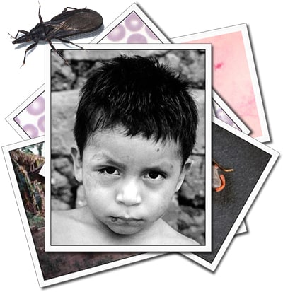 A stack of photos related to Chagas Disease with a picture of a boy with obvious symptoms on the top.