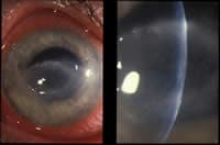 Eye of patient with Acanthamoeba keratitis