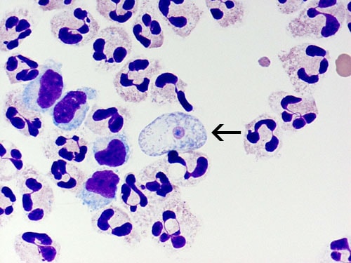 A cytospin of fixed CSF showing a Naegleria fowleri trophozoite stained with Giemsa-Wright amidst polymorphonuclear leukocytes and a few lymphocytes. Within the trophozoite, the nucleus and nucleolus can be seen. Magnification: 1000x
