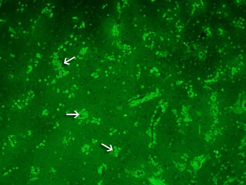 A section of the cerebral portion of the brain from a PAM patient reacted with the specific anti-Naegleria fowleri antibody which has been conjugated to a fluorescent antibody (immunofluorescent staining) viewed using microscopy with an exciter filter. Note the large numbers of Naegleria fowleri trophozoites staining bright green. No cysts are seen. Magnification: 100x
