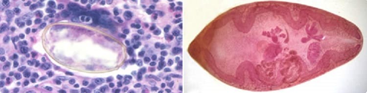 Left: Eggs of Paragonimus sp. taken from a lung biopsy stained with hematoxylin and eosin (H%26amp;E). These eggs measured 80-90 %26micro;m by 40-45 %26micro;m. The species was not identified in this case. Right: P. westermani adult, this approximately 1cm long fluke is viewed under magnification.
