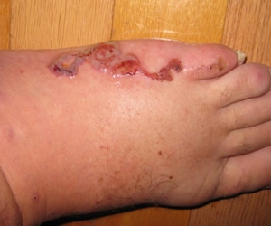 Cutaneous larval migrans (CLM) in a person's foot. Courtesy Vince Conte, MD, Miami-Dade County Health Department