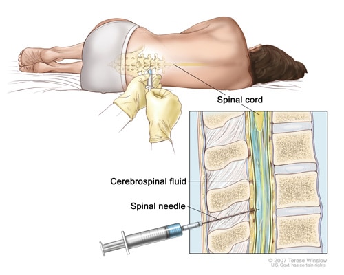 Illustration of a woman lying on her side having a lumbar puncture procedure and of the procedure.