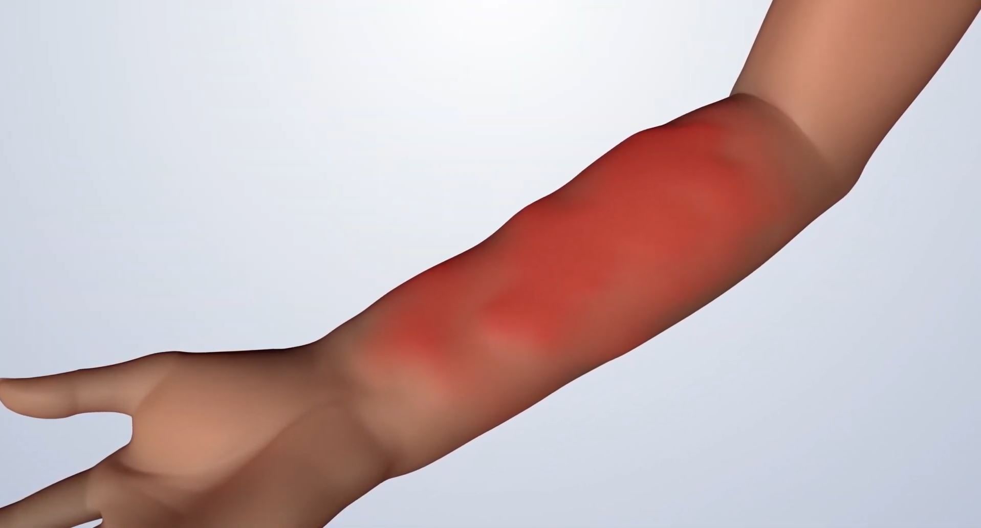 Arm with swelling and redness as a result of acute radiation syndrome