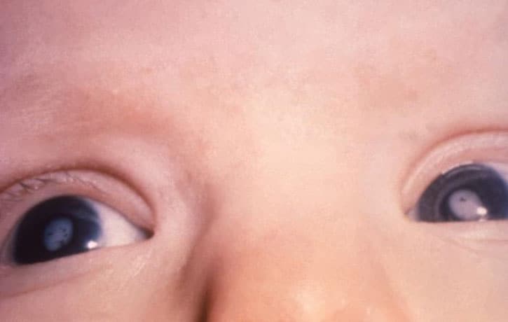 close-up of a sick baby’s eyes with rubella