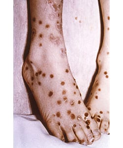 Feet of patient with modified-type smallpox. There is a “cropping” of the lesions in their distribution pattern. The rash resembles varicella. Source: CDC/Dr. Robinson.