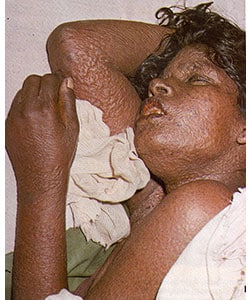 Woman with flat-type smallpox on 6th day of the rash. Image shows crepe-like lesions on her arms, hands, neck, and face. Source: Fenner F, Henderson DA, Arita I, Ježek Z, Ladnyi ID. Smallpox and its eradication. Geneva, Switzerland: World Health Organization; 1988 (p.33)