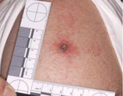 Arm of patient with central lesion at smallpox vaccination site. Ruler showing diameter of lesion is approximately 1 centimeter. Central lesion shows a successful “take.” Source: Ramzy Azar, LTJG, MSC, United States Navy: National Naval Medical Center, Bethesda, MD.
