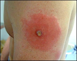 A patient’s arm showing a robust take.  The patient’s vaccination site is surrounded by a large area of erythema and swelling, and shows lymphangitic streaking. Source: CDC