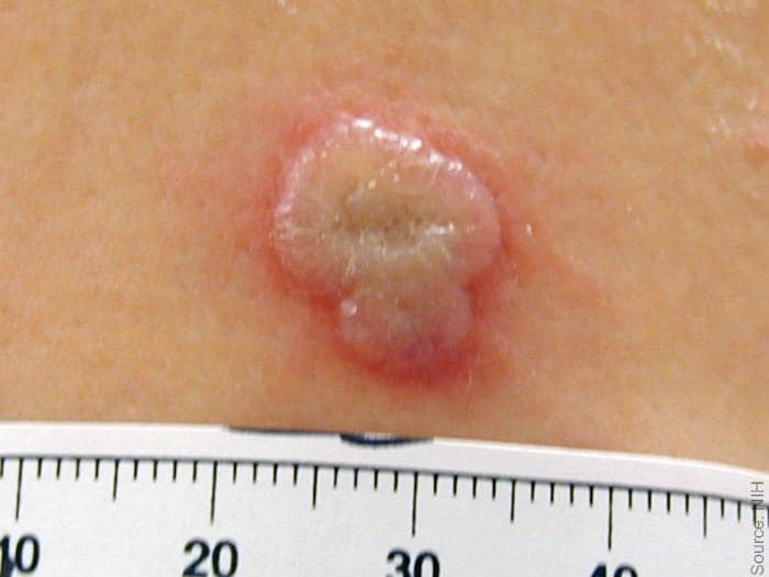 Normal primary, 8 days post vaccination. Bi-lobed normal pustule with minimal surrounding erythema at 8 days post vaccination. Source: NIH, digital enhancement %26copy; Logical Images.