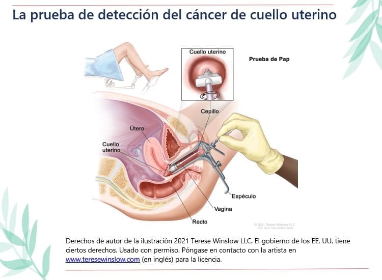Diagrama de una prueba de detección del cáncer de cuello uterino