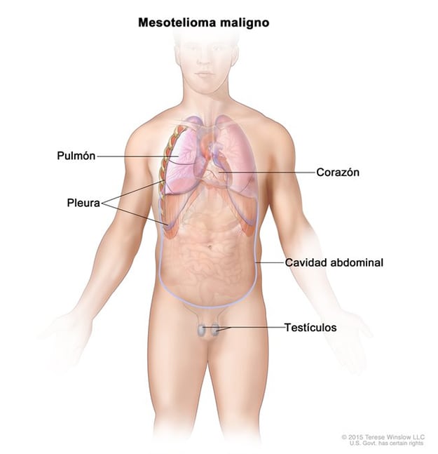 Dibujo ilustra las partes del cuerpo donde se puede formar el mesotelioma maligno.