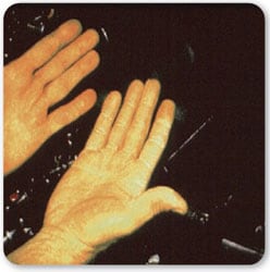 Vista de dos manos, con las palmas hacia arriba, mostrando los efectos de resequedad