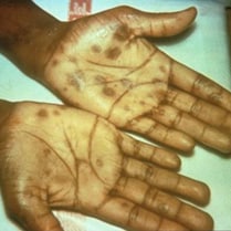 Secondary rash from syphilis on palms of hands.