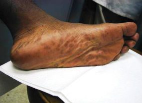 Secondary stage syphilis sores (lesions) on the bottoms of the feet. Referred to as plantar lesions.
