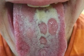 Lesions of secondary syphilis.