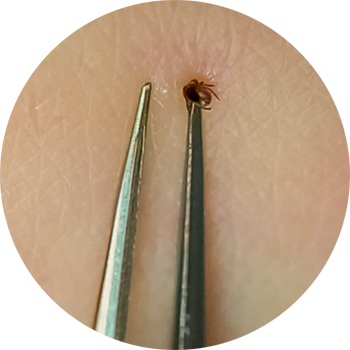 Embedded tick being grasped by a pair of tweezers