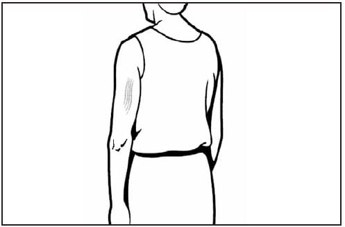 This line drawing is a rear/dorsal view of an adult. The triceps muscle of the arm is shaded, showing the proper site for subcutaneous vaccine administration.