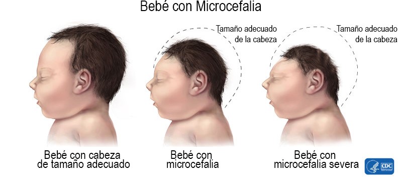 Image of three babies heads.  One normal, one with microcephaly, and one with severe microcephaly.