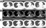 Thumbnail of Computed tomography images of the lungs of a a 65-year-old woman with community-acquired pneumonia caused by Legionella pneumophila bacteria, China, showing absorption of infusion in left lobes after effective treatment. Lung window (A) and bone window (B) at the beginning of treatment showed consolidation in the left lobes; after 1 week of treatment (C), infusion is mostly absorbed in the left lobes.