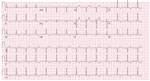 An electrocardiogram of a healthy 37-year-old man (patient 2) with monkeypox, shortness of breath, and decreased exercise tolerance shows normal sinus rhythm with T wave inversions in the inferior and anterolateral leads.
