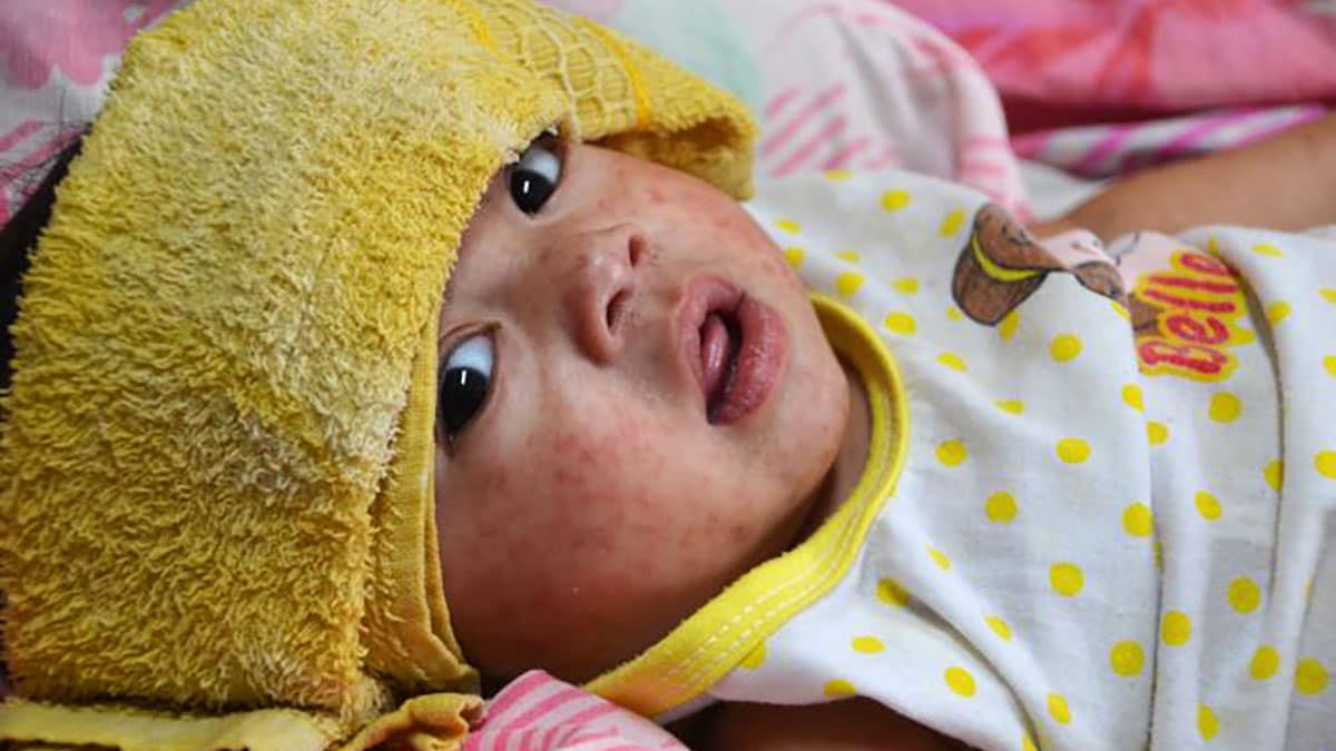 A baby with measles in a hospital bed.