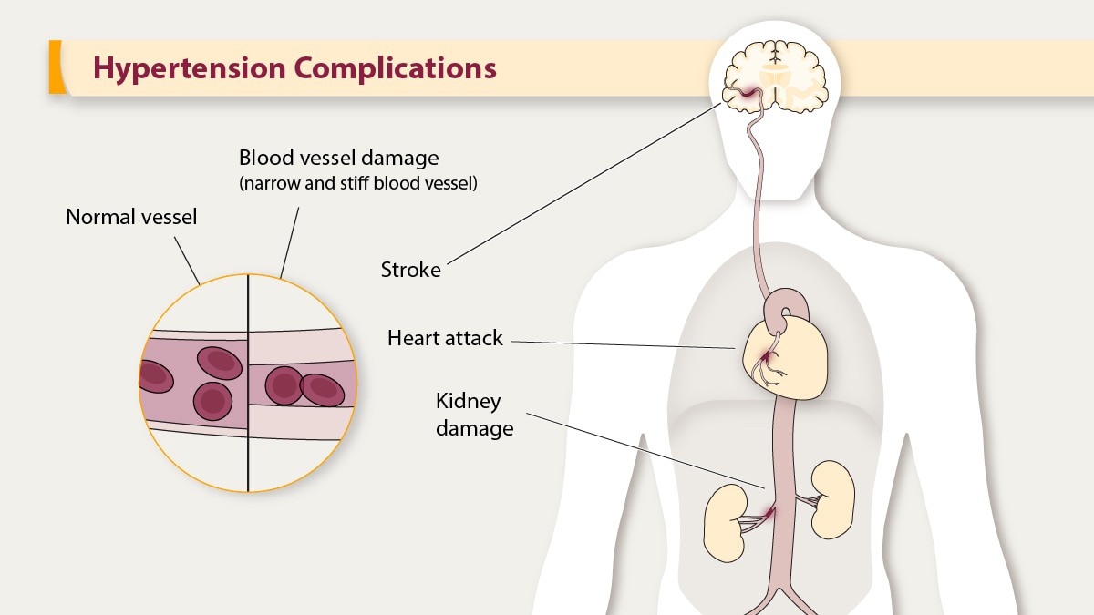 Hypertension complications: stroke, heart attack, kidney damage.