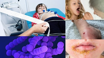 Collage of images representing group A strep bacteria and some of the infections they can cause: strep throat, cellulitis, impetigo, and rheumatic fever.