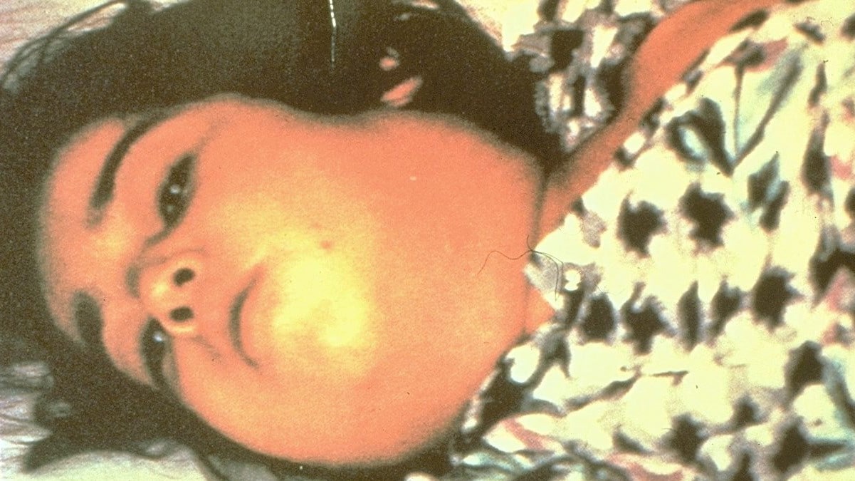 Child with cervical swelling, referred to as bull neck, which is a symptom of diphtheria.