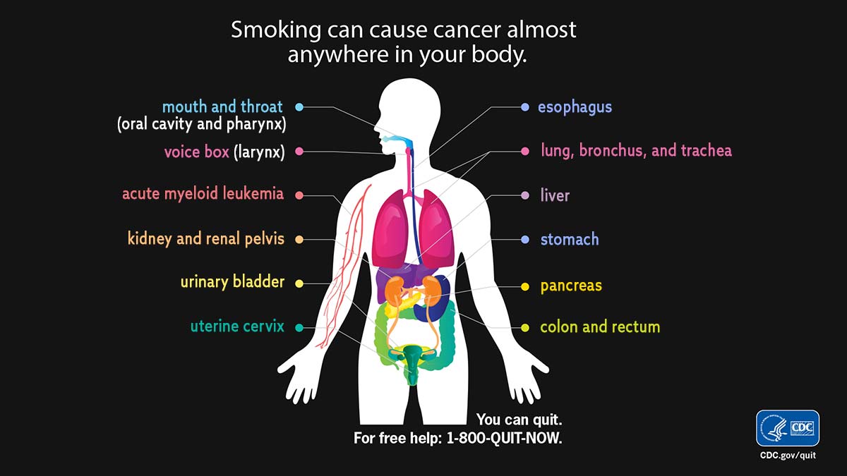 Diagram of human body labeled with areas/organs that can develop smoking-related cancers.