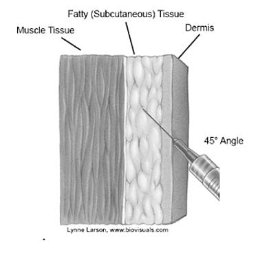 Figure 1: image of needle entering Fatty (subcutaneous) tissue, at 45 degree angle, through the dermis, stopping before the muscle tissue. by Lynne Larson. www.biovisuals.com
