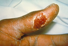 An ulcer caused by <em>Francisella tularensis</em>.