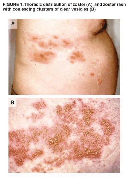 FIGURE 1. Thoracic distribution of zoster (A), and zoster rash
with coalescing clusters of clear vesicles (B)