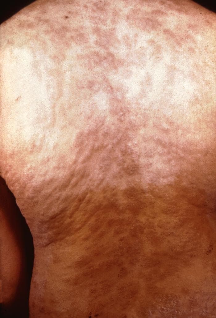 Secondary syphilis rash on the back.