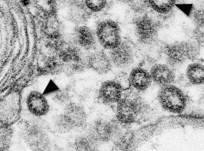 This transmission electron micrograph from a tissue culture isolate reveals a number of severe acute respiratory (SARS) virus particles, which are members of the family Coronaviridae.