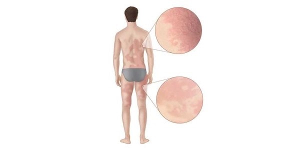 Diagram of man’s body showing red rash all over