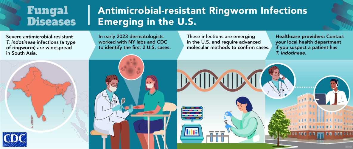 Antimicrobial-resistant Ringworm Infections Emerging in the U.S.