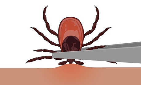 Clip art image of a tick being pulled from skin by a pair of tweezers.