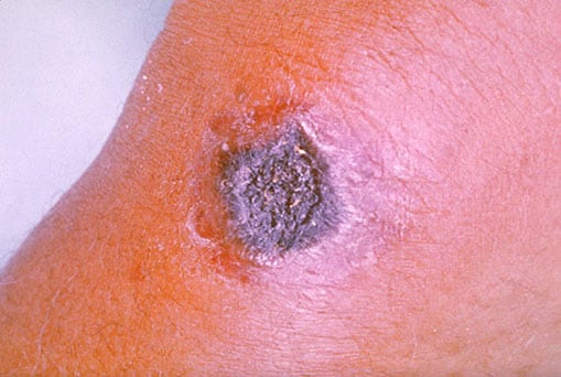 This image depicts the surface of a patient’s forearm, on which you’re able to see an example of a cutaneous anthrax lesion, caused by the bacterium, Bacillus anthracis.
