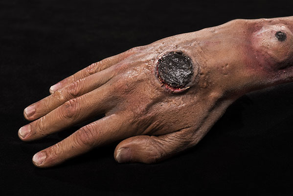 Cutaneous Anthrax on Arm.